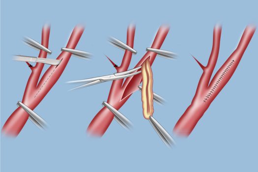 carotid-endarterectomy-lg